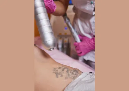 How Q-Switched Lasers Are Used For Tattoo Removal