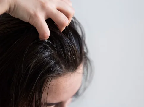 How to Avoid Extreme Dandruff in Winters: Expert Hair Care Tips