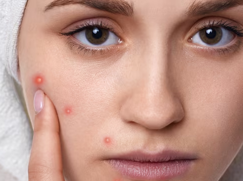 Pimple Popping: Is It Safe or Harmful for Your Skin?