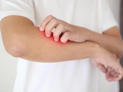 Heat Rash vs Skin Allergy: How to Tell the Difference