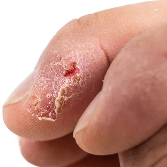 Best Fungal infection treatment in Noida, skin infection cost in Noida