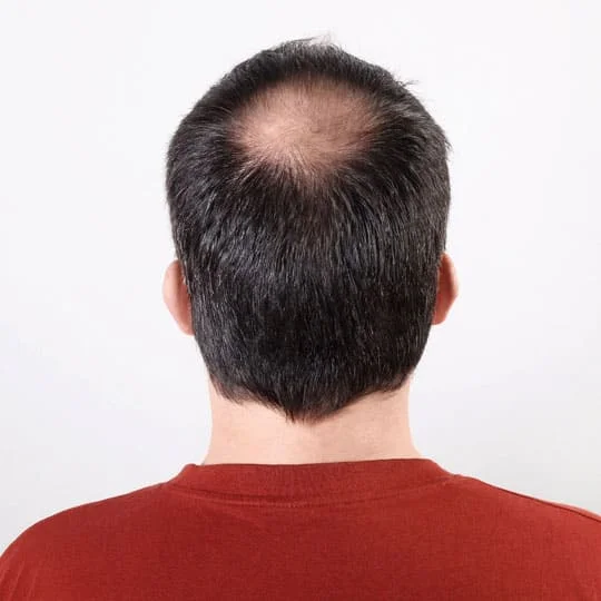 Scarring Alopecia and Hair Regrowth