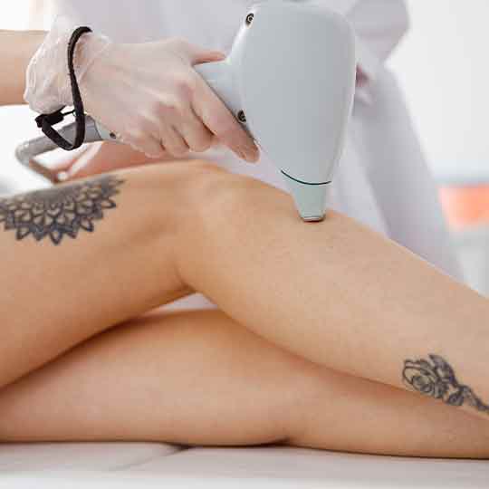 Laser Tattoo Removal Treatment in Noida, Tattoo Removal in Noida