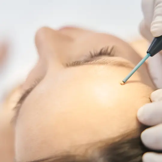Mole Removal Treatment | Skinlogics Clinic