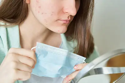 Acne Treatment in Noida, Acne Treatment Clinic in Noida