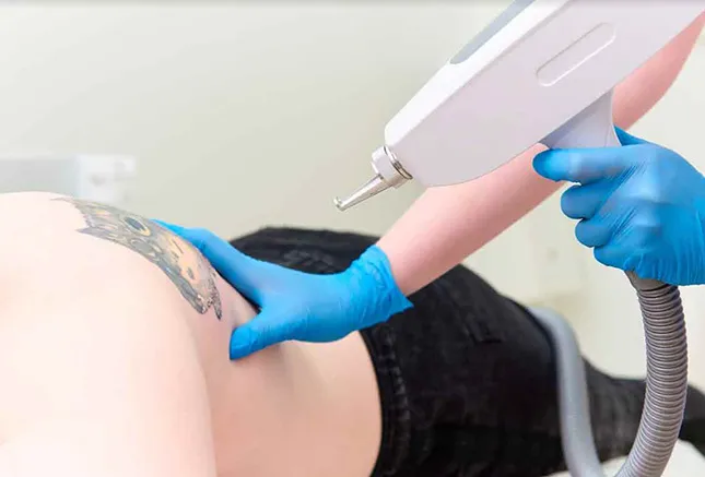 Laser Tattoo Removal in Noida Laser Tattoo Removal in Noida