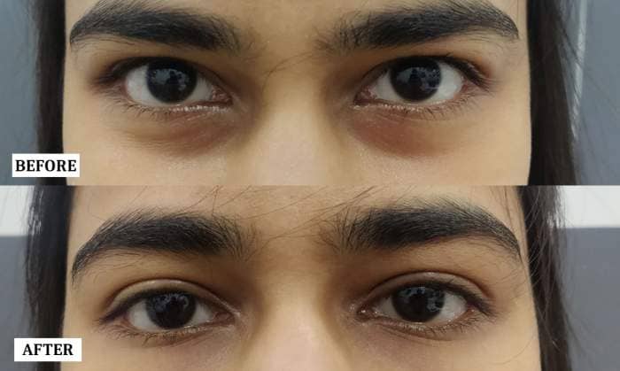 Eye Rejuvenation