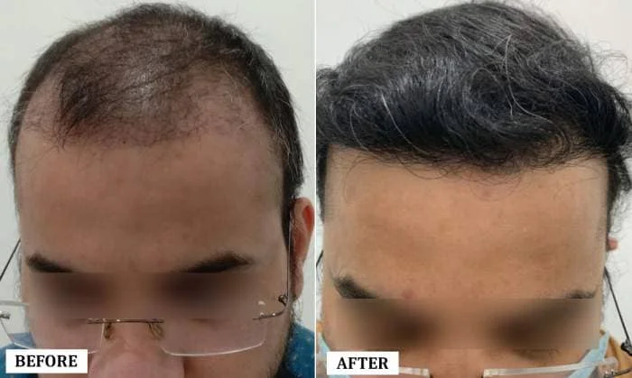 Hair Transplant