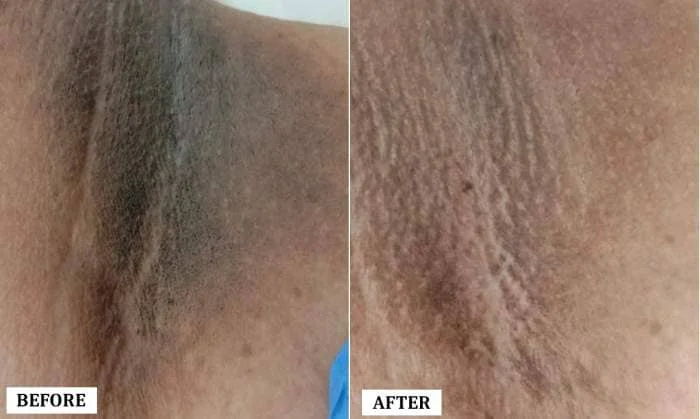 Underarms Pigmentation Treatment