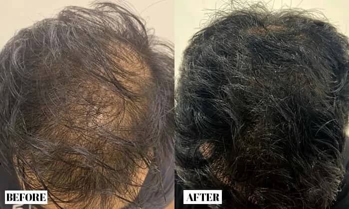 Hair Regrowth Treatment