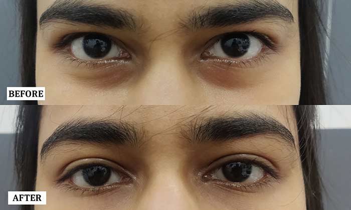 Under Eye Hollowness Treatment Before and After | Under Eye Hollowness Treatment Before and After Results