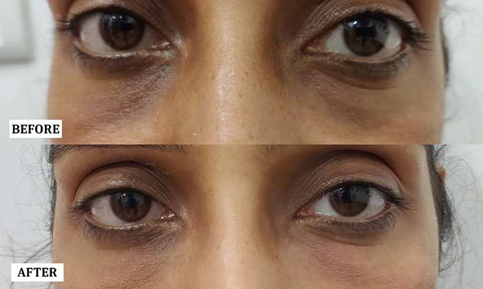 Under Eye Hollowness Treatment Before and After | Under Eye Hollowness Treatment Before and After Results