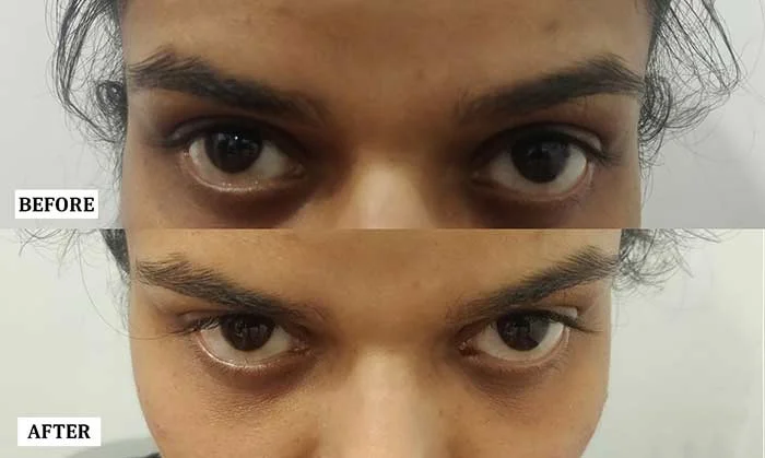 Under Eye Hollowness Treatment Before and After | Under Eye Hollowness Treatment Before and After Results