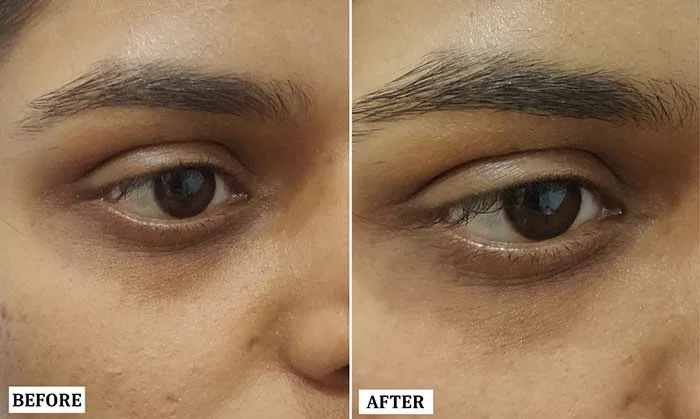 Under Eye Filler