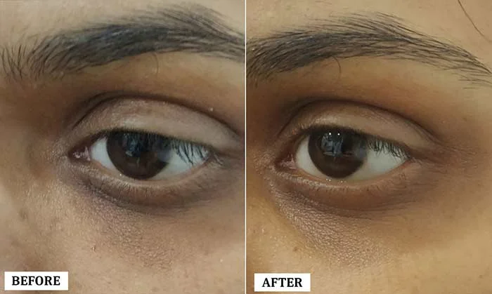 Under Eye Filler