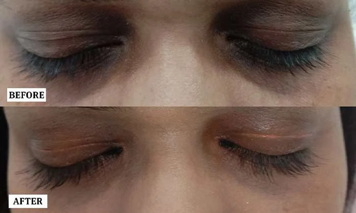 Under Eye Treatment Before and After | Under Eye Treatment Before and After Results