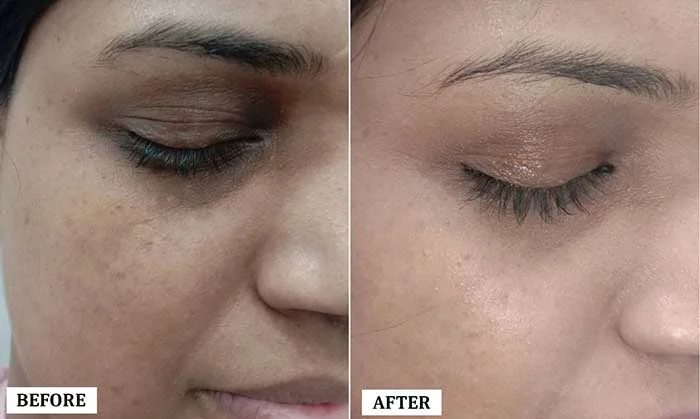 Under Eye Treatment Before and After | Under Eye Treatment Before and After Results