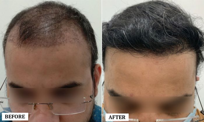 Hair Transplant Surgery Before and After | Hair Transplant Surgery Before and After Results