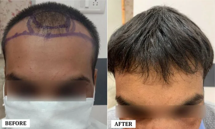 Hair Transplant Surgery Before and After | Hair Transplant Surgery Before and After Results