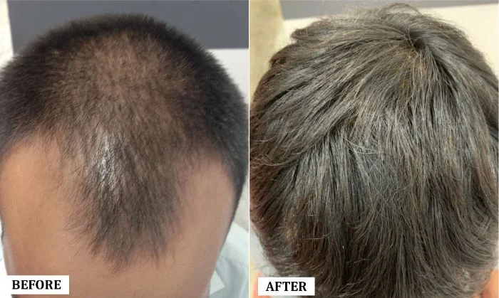 Hair Transplant Surgery Before and After | Hair Transplant Surgery Before and After Results