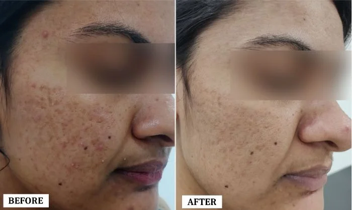 Acne Scar Removal Treatment Before and After | Acne Scar Removal Treatment Before and After Results