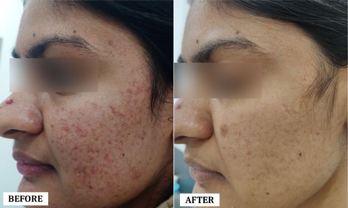Acne Scar Removal Treatment Before and After | Acne Scar Removal Treatment Before and After Results