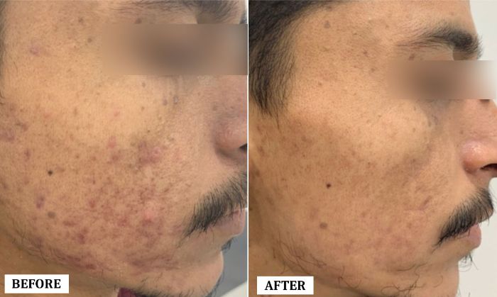 Acne Scar Removal Treatment Before and After | Acne Scar Removal Treatment Before and After Results