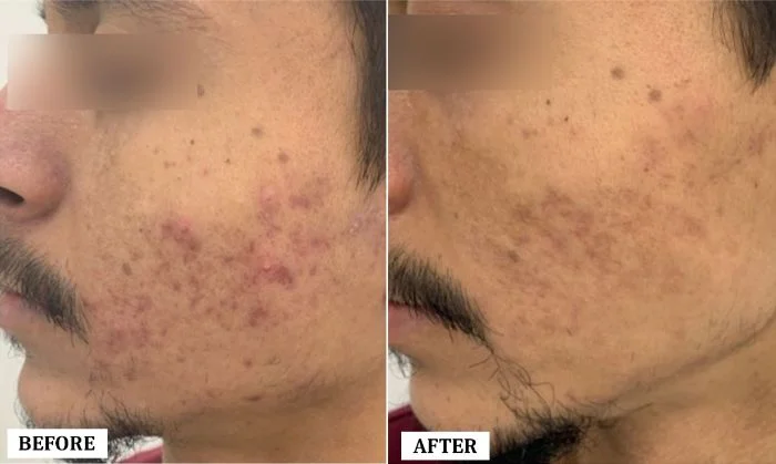 Acne Scar Treatment