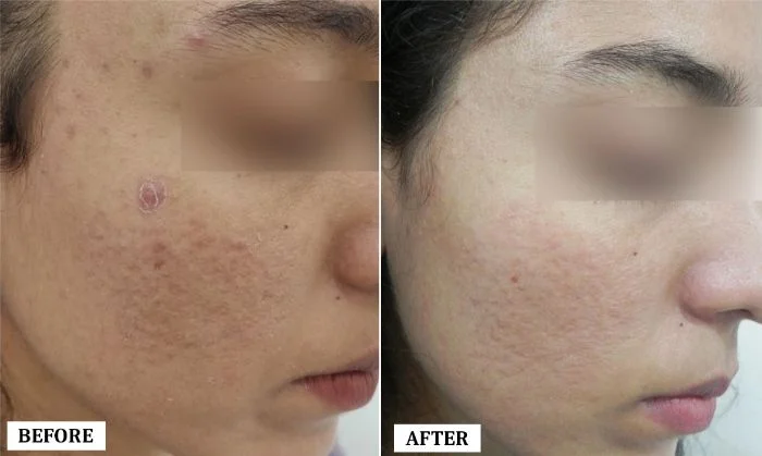 Acne Scar Treatment