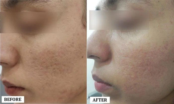 Acne Scar Treatment