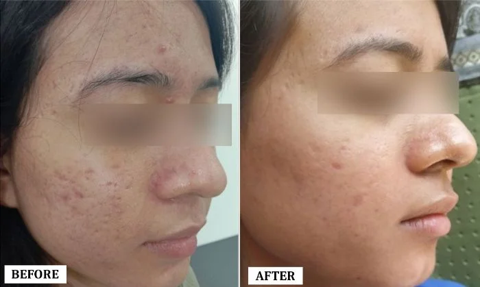 Acne Scar Treatment