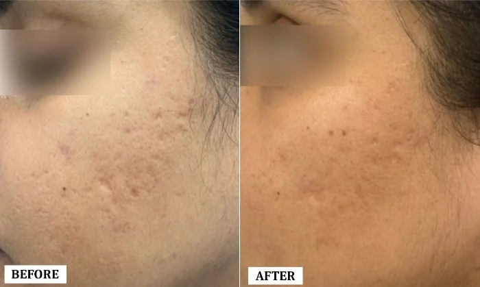 Acne Scar Treatment