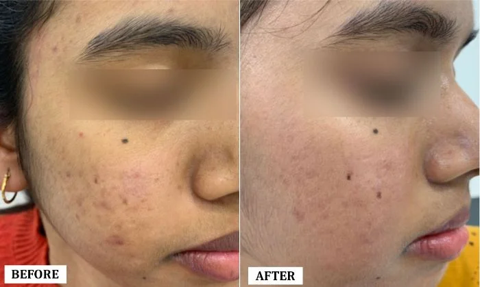 Acne Scar Treatment