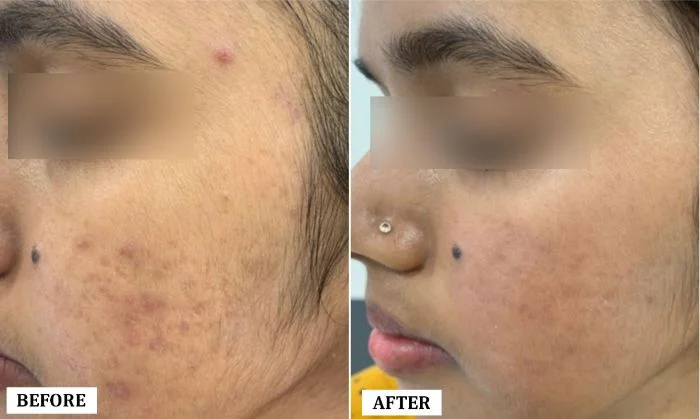 Acne Scar Treatment