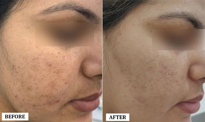 Acne Scar Treatment