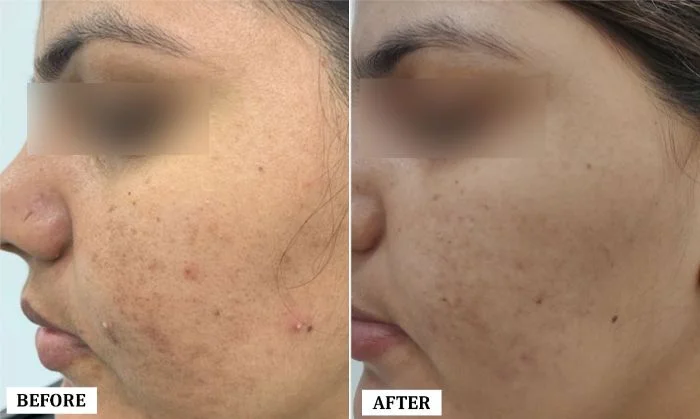 Acne Scar Treatment