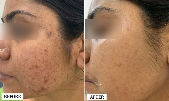 Acne Spot Treatment