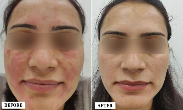 Skin Problem Treatment Before and After | Skin Problem Treatment Before and After Results