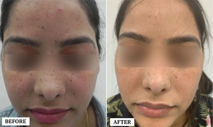 Freckle Removal Treatment Before and After | Freckle Removal Treatment Before and After Results