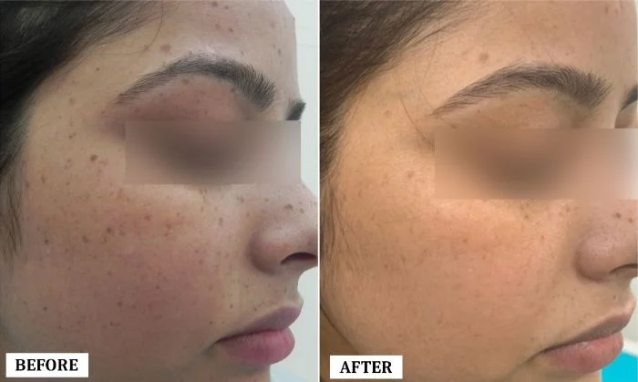 Freckle Removal Treatment Before and After | Freckle Removal Treatment Before and After Results