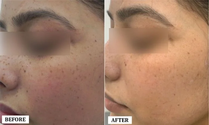 Freckle Removal Treatment Before and After | Freckle Removal Treatment Before and After Results