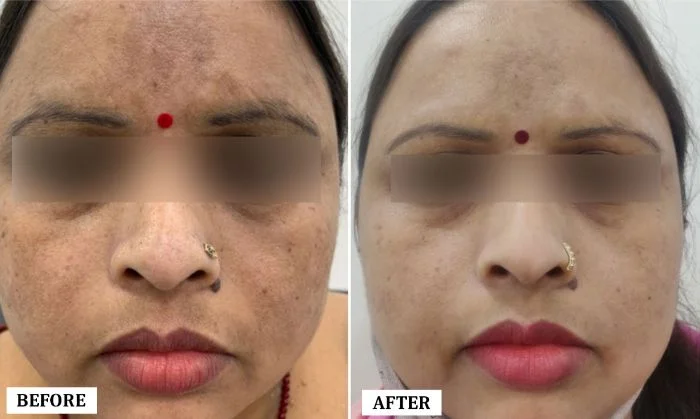 Melasma Treatment Before and After | Melasma Treatment Before and After Results