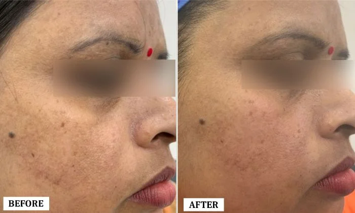 Melasma Treatment Before and After | Melasma Treatment Before and After Results