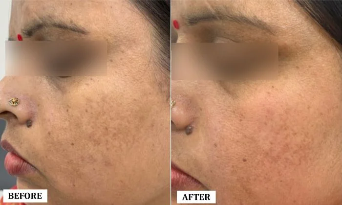 Melasma Treatment Before and After | Melasma Treatment Before and After Results