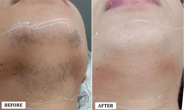Laser Hair Reduction Treatment Before and After | Laser Hair Reduction Treatment Before and After Results