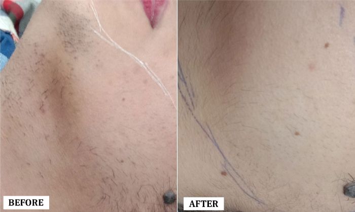 Laser Hair Reduction Treatment Before and After | Laser Hair Reduction Treatment Before and After Results