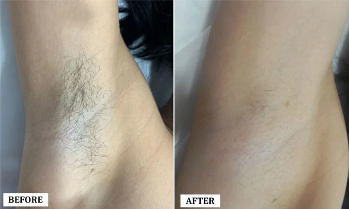 Laser Hair Reduction Treatment Before and After | Laser Hair Reduction Treatment Before and After Results