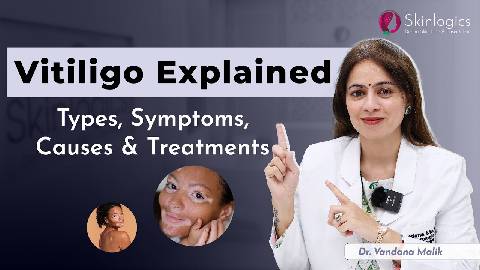 Vitiligo/Leucoderma | Causes and Treatment | Best Skin Specialist in Noida | Dr. Vandana Malik