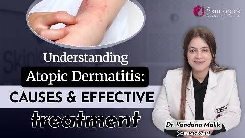 Atopic Dermatitis (Eczema) | Causes & Treatment | Best Skin Clinic in Noida | Skinlogics Clinic