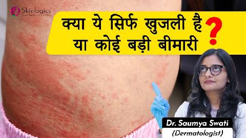 Urticaria Treatment in Hindi (Skin Allery) | Best Skin Specialist in Noida | Skinlogics Clinic